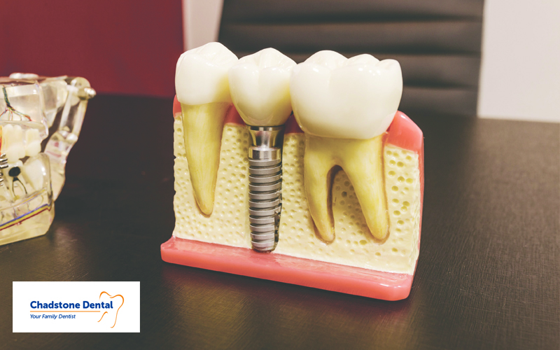 cosmetic dental implants - Chadstone Dental